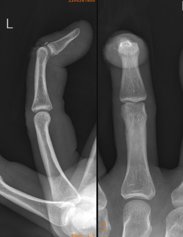 Mallet finger The Bone School